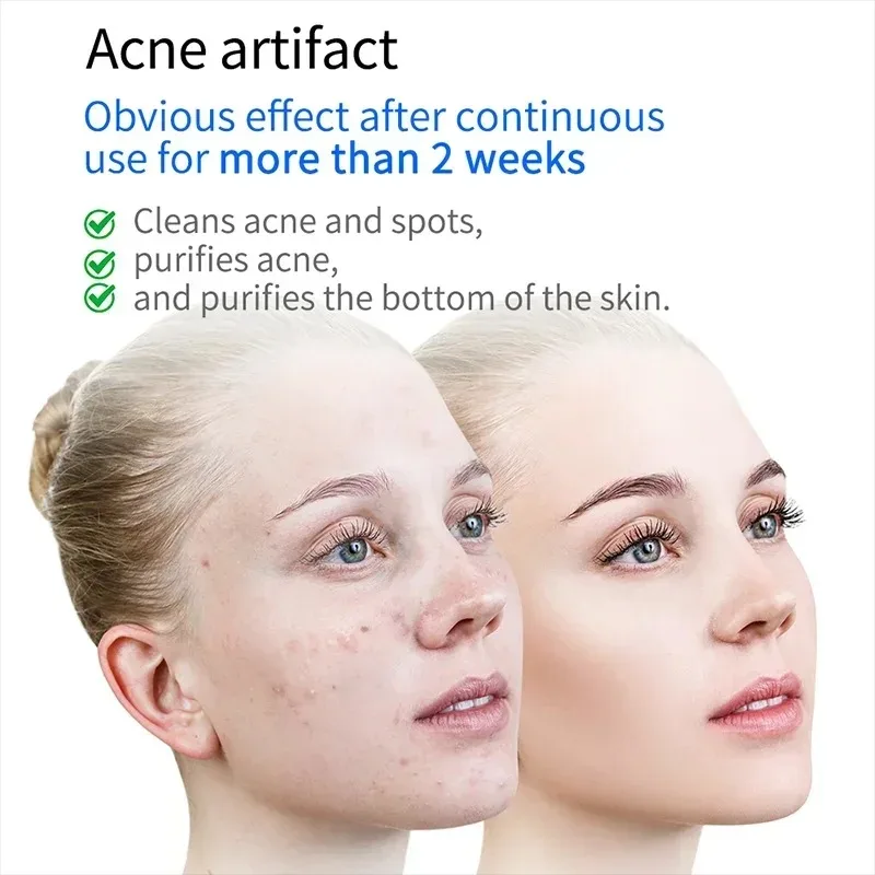 เครื่องนวดหน้าพลาสม่าแสงสีฟ้าเลเซอร์โอโซนอุปกรณ์กําจัดรอยแผลเป็นสิวเครื่องต่อต้านริ้วรอย Skin Care อุปกรณ์ความงาม