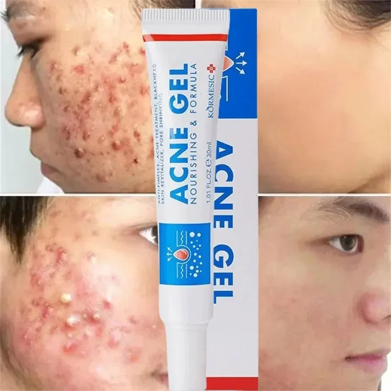 كريم فعال لإزالة حب الشباب مضاد لحب الشباب إصلاح احمرار بثرة البقع جل التنظيف العميق المسام السيطرة على النفط ترطيب العناية بالبشرة 30 جرام #3