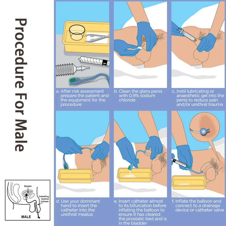 يمكن التخلص منها 10 مل سيليكون Fr18 قسطرة فولي حجم 16 قسطرة بالون الإحليل فائقة التشحيم مع اتجاهين
