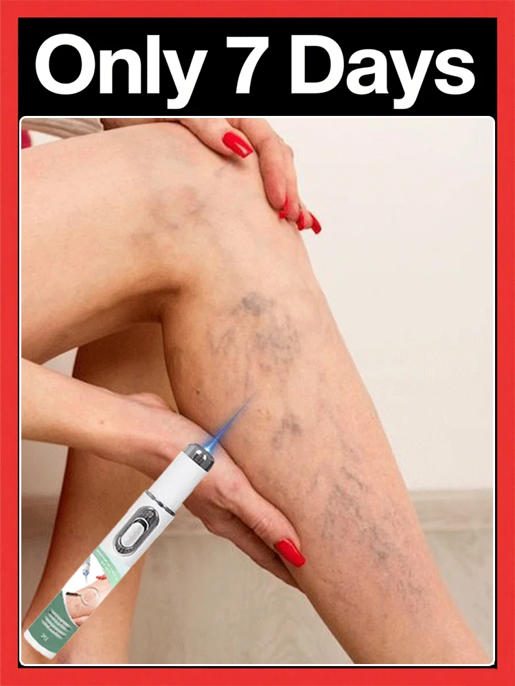 

blue light upgraded style Says Goodbye To Spider Legs Varicose In 7 Days，， Athletic Performance and Recovery