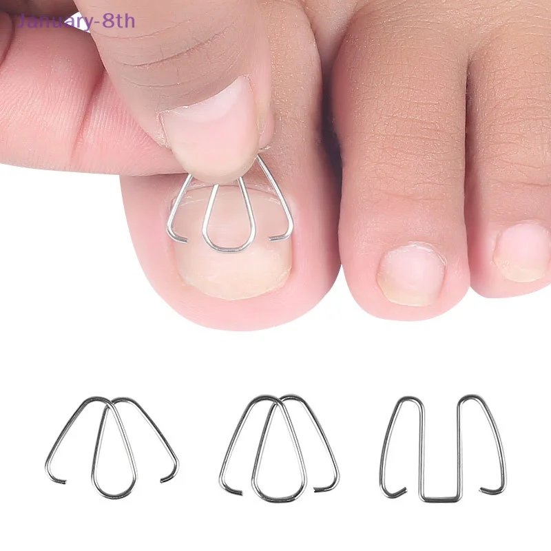 Corrector De Unha Engrown, Ferramentas De Cuidados Com Os Pés, Grampos De Endireitamento De Fio, Fixador De Unha De Toe, Gancho Para Unha De Toe