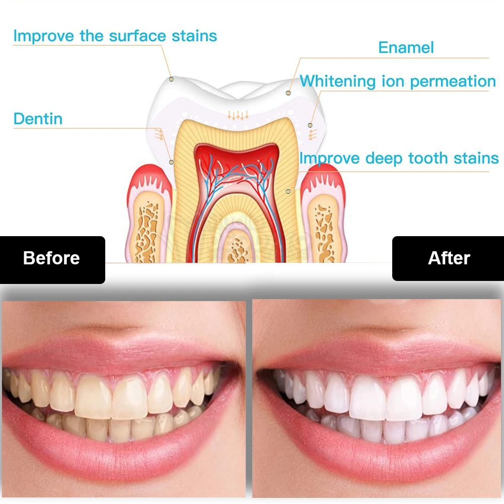 Dentes branqueamento kit, Mini 16 LED luz fria, 35% de peróxido de carbamida gel branqueador, caneta branqueadora, conjunto de dispositivos de