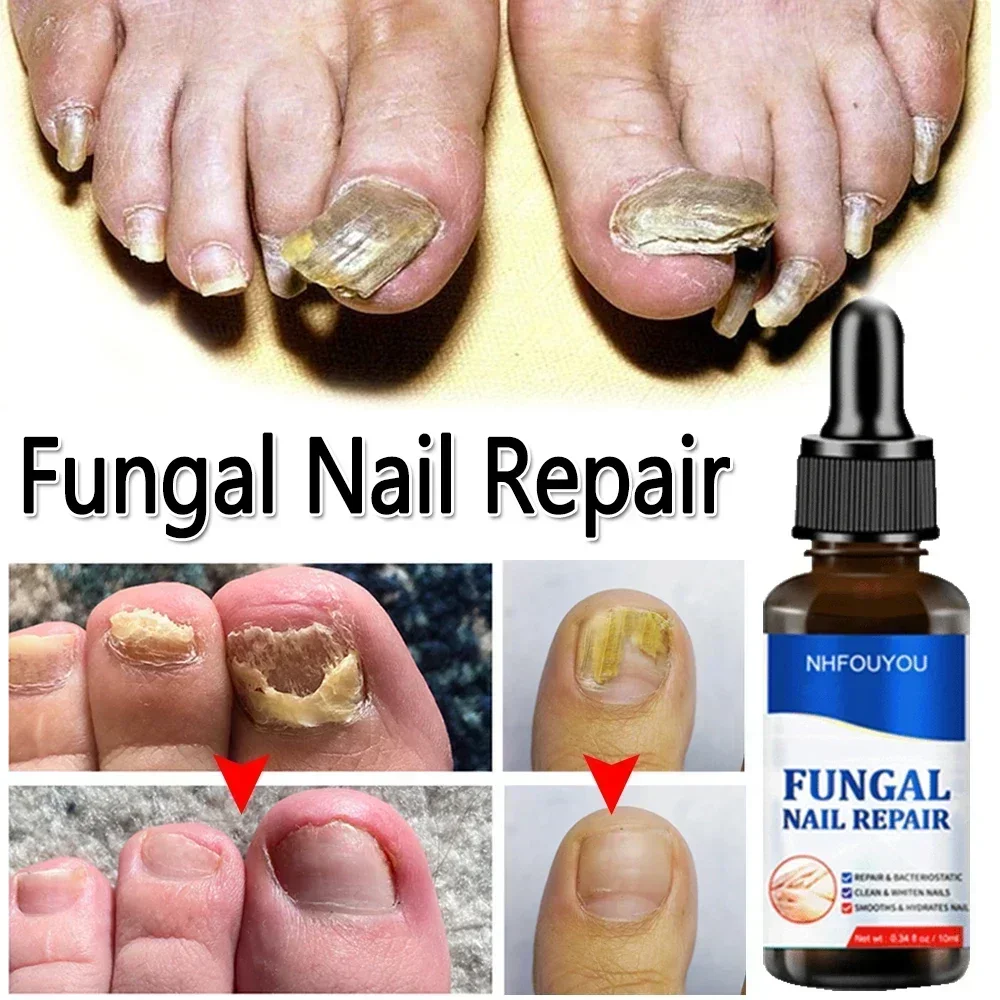 

Nail Fungals Renewal Nail Repair Liquid for Discolored Thickened Crumbled Nails Nail Fungals for Discolored Broken Cracked S5F6