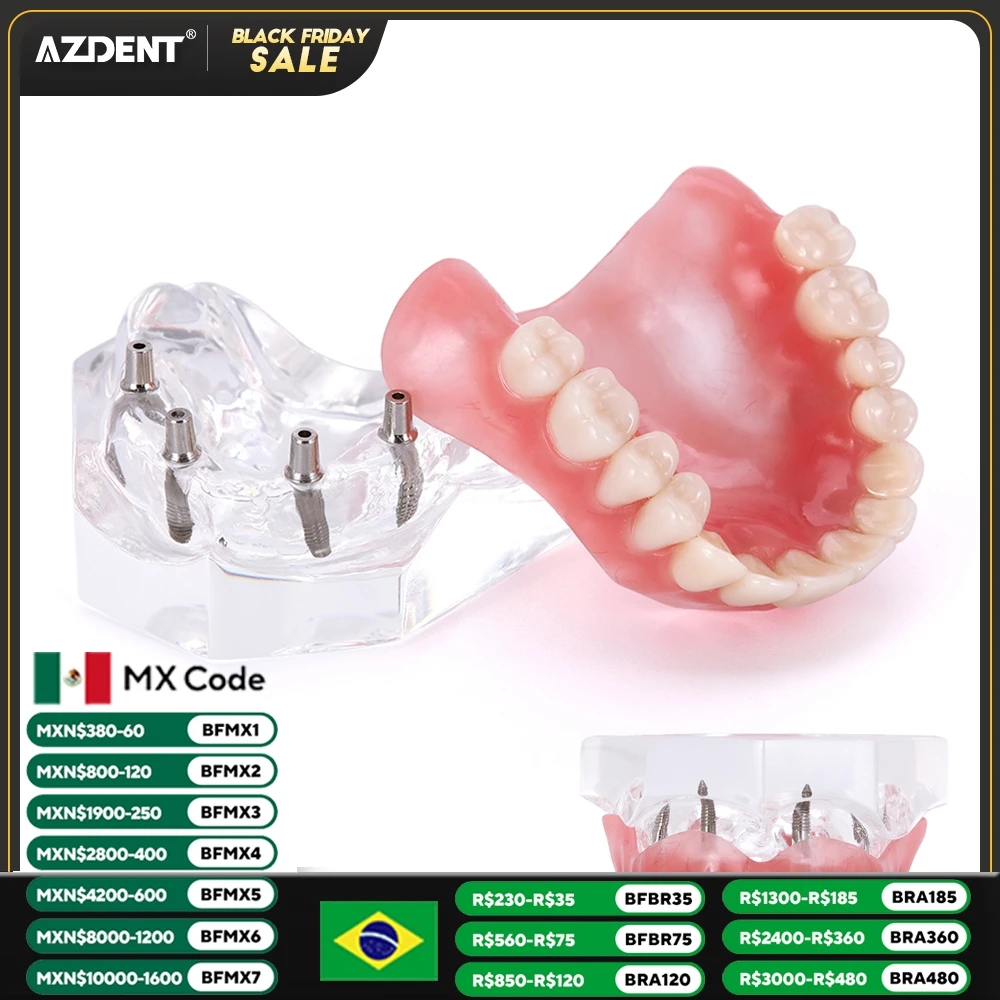 AZDENT Dental Teeth Model Demo Overdenture Restoration With Implants upper/Lower Dentist Student Learning Model