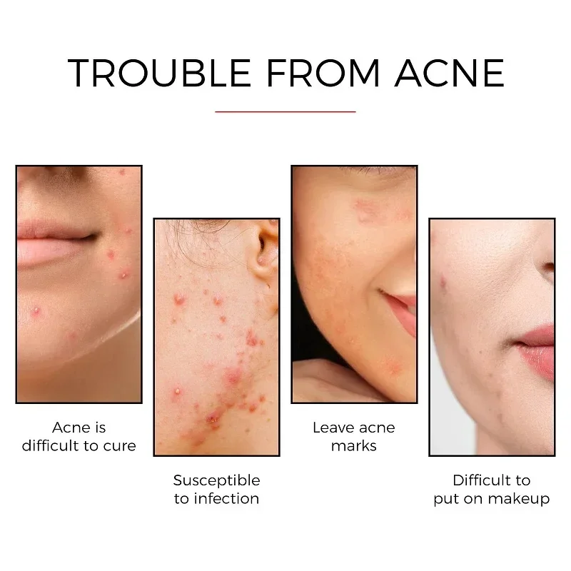 Acne Pimple Spot Cicatriz Cuidado Corretivo Adesivo, Ferramentas De Cuidados Com A Pele Facial, Melhorar A Coceira Facial, Remendos De Limpeza, Produtos De Beleza