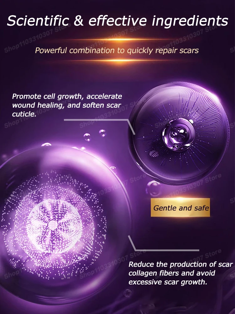 Laser therapy Keloid scar