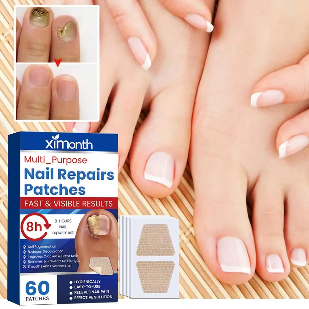 1box Nail Repair Patch Grey Fungal Nails Thickening Soft Paronychia Treatment Anti Infection Correction Sticker Ingrown Toenail