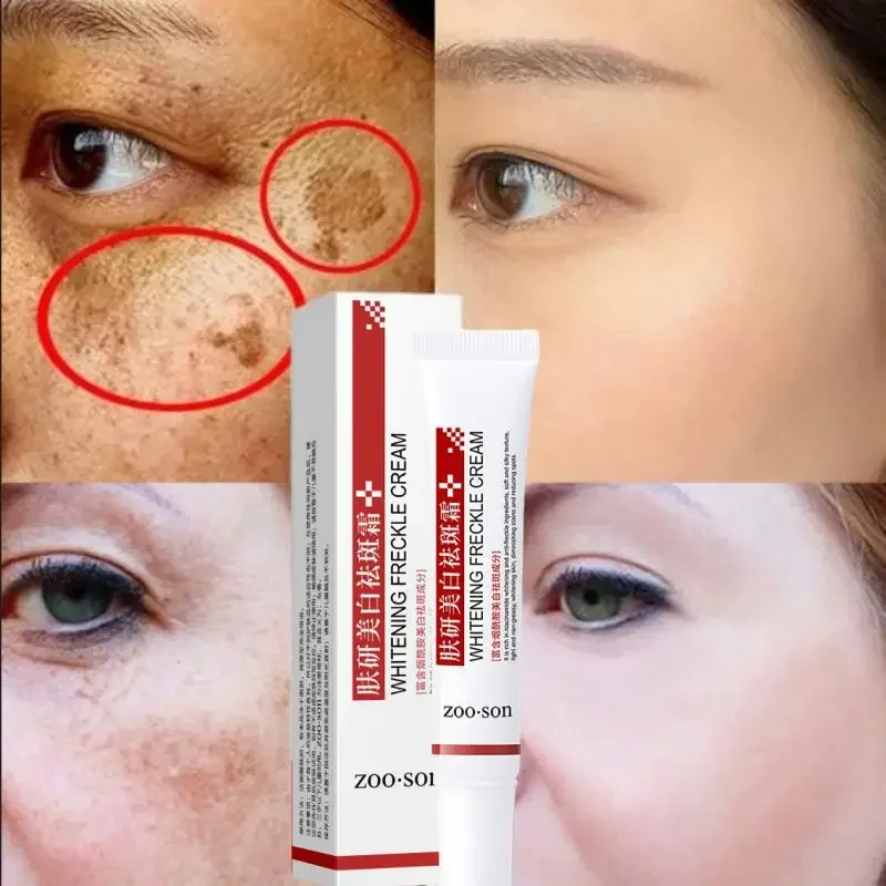 Eficaz Whitening Freckle Cream, Niacinamida, Remova manchas escuras, Anti Freckle, Fade Pigmentation, Cremes de melasma, Skin Care