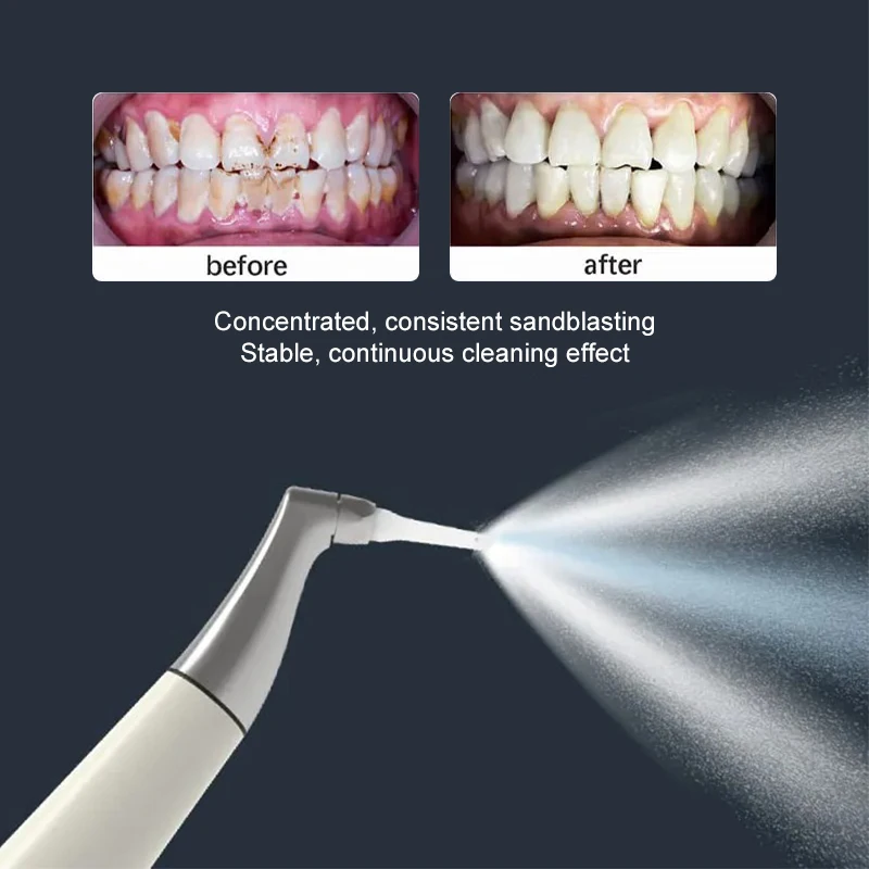 

VVDental Air Jet Dental Sandblaster 4/2 Holes Air Polisher for Stain and Plaque Removal Quick Connect Dental Tools