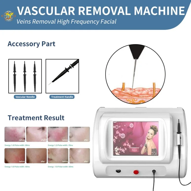 

High Frequency Nail Fungus Removal R-F High Frequency For Spider Blood Vessels Removal Blood Vessels Facial Vascular Spider Vein