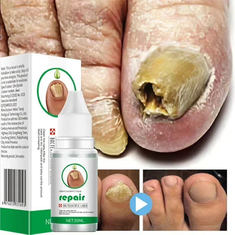 

Nail Fungus Treatment Serum Toe Fungal Repair Products Hand Foot Care Removal Gel Anti Infection Onychomycosis Paronychia