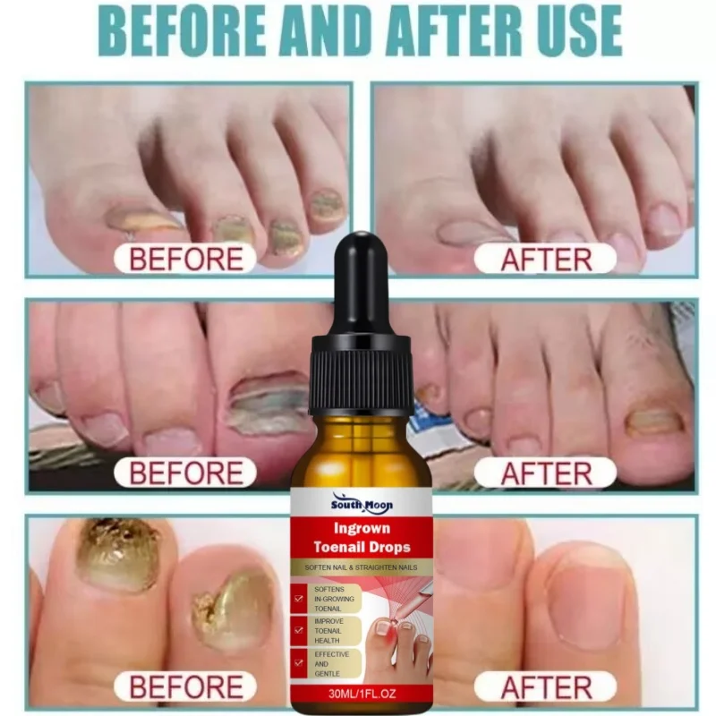 Nail fungal Treatment Serum Foot Fungus Remedy Removal Products Anti Infection Onychomycosis Paronychia Repair Gel Care 30ml