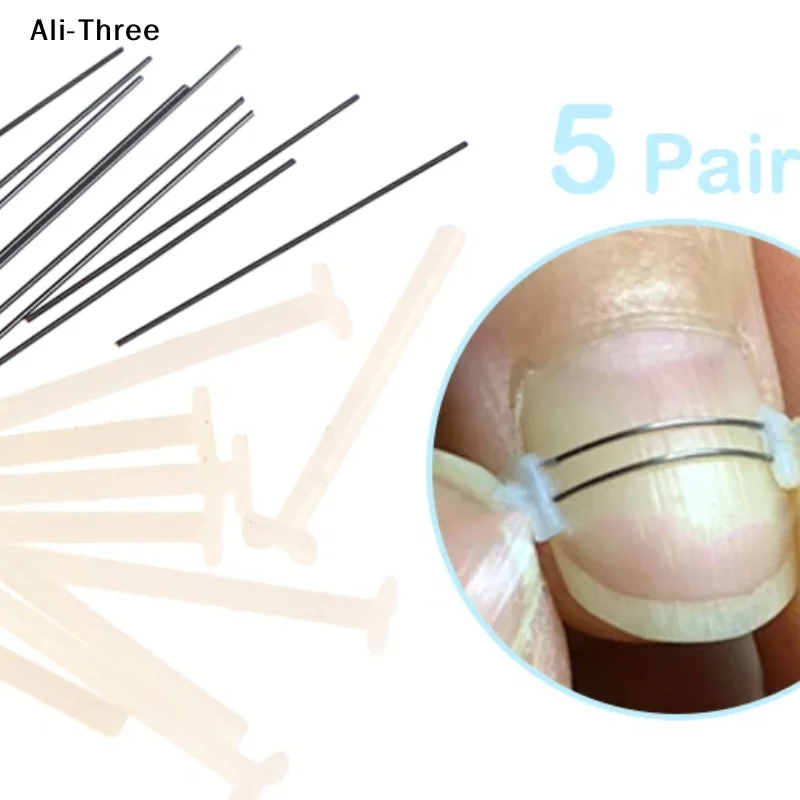 Ingrown Toenail Cor…