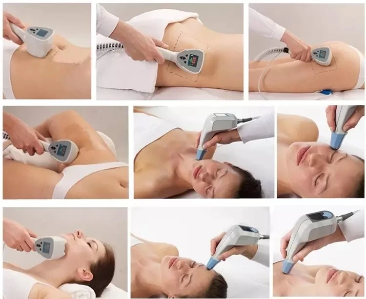 Ultra 360 Hautstraffung, Kollagenpistole, Cellulite-Reduktion, 2-in-1, unipolare Straffung der Haut, Körper, Abnehmen, Facelifting, Schönheitsmaschine – Detail 10