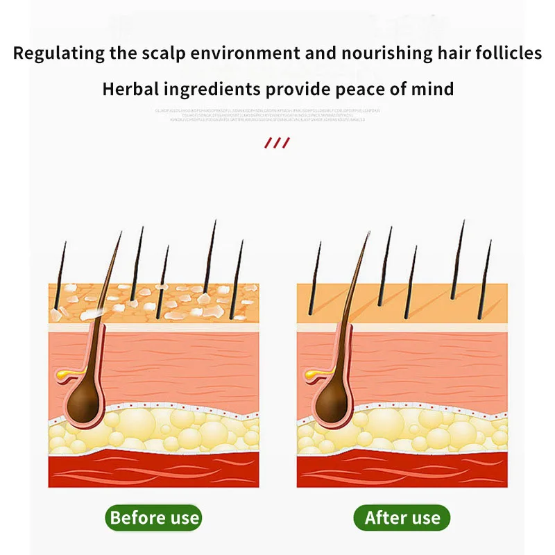 Sophora Flavescens Crema per follicoli piliferi Lenisce i follicoli piliferi danneggiati e brufoli del cuoio capelluto intasati Olio per la testa Prurito Crema sanitaria esterna
