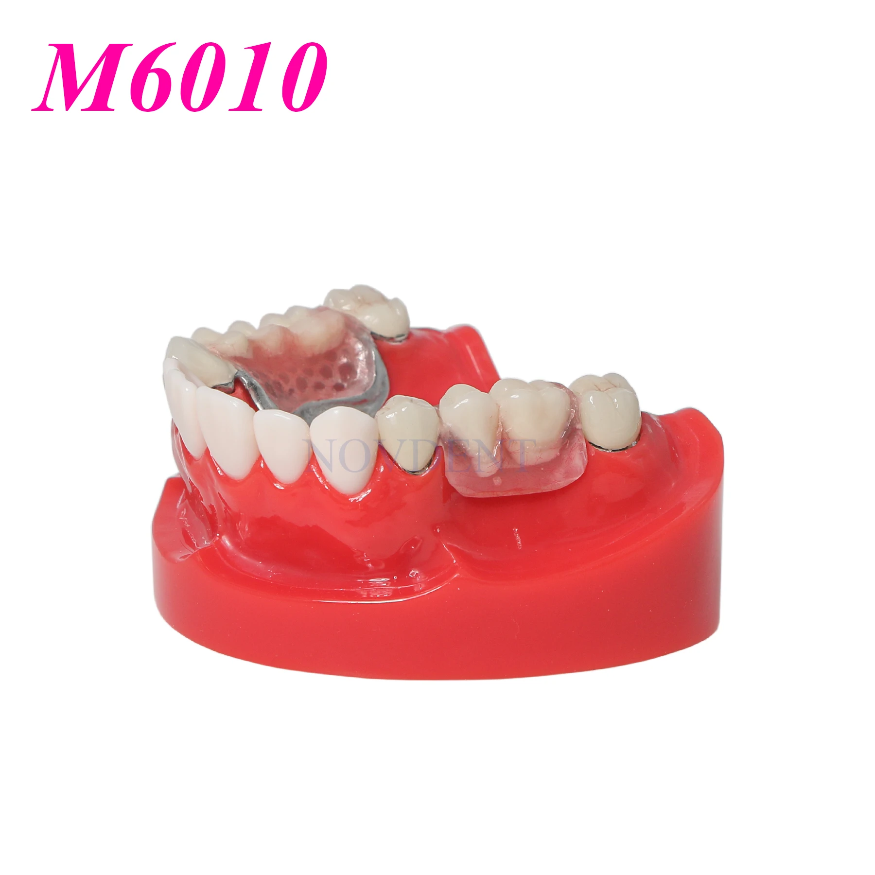 Dental Teeth Implant Model Typodont Restoration Telescope Crown Orthodontic Restoration Model M6010