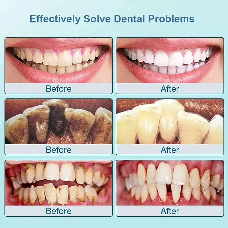 Removedor de cálculo dentário, Clareamento dos dentes, Remoção do odor bucal, Mau hálito, Prevenindo a periodontite