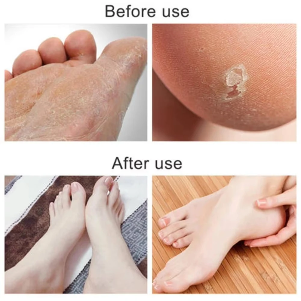 قطعة واحدة من جهاز تنظيف القدمين من الفولاذ المقاوم للصدأ لإزالة الجلد الميت ومسامير القدم، أداة العناية بالقدم، متوفرة بألوان متعددة