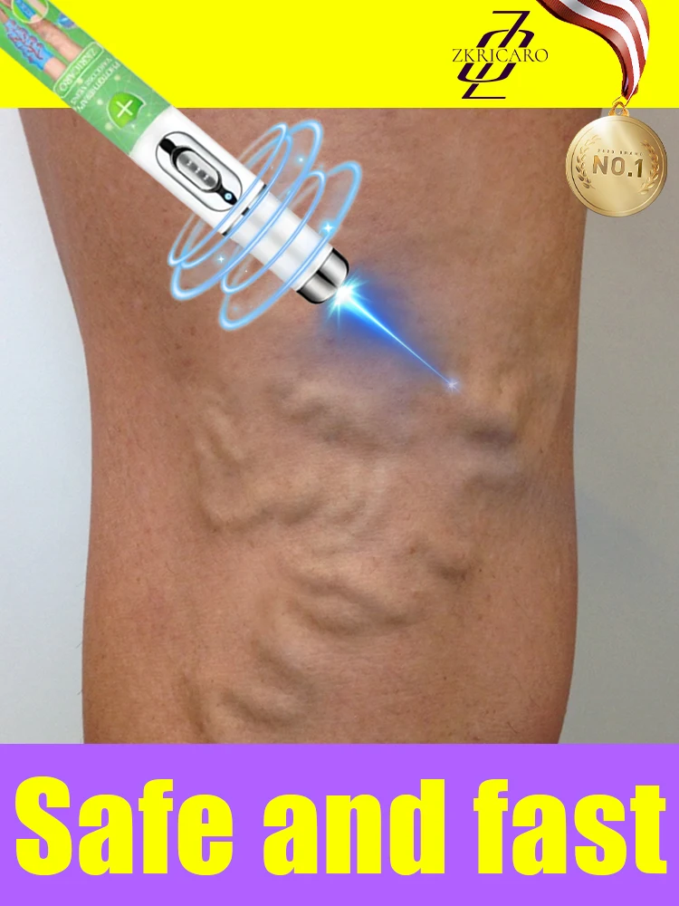 

ᴸᵃˢᵉʳ ᵛᵃʳⁱᶜᵒˢᵉ ᵛᵉⁱⁿˢLaser varicose veins