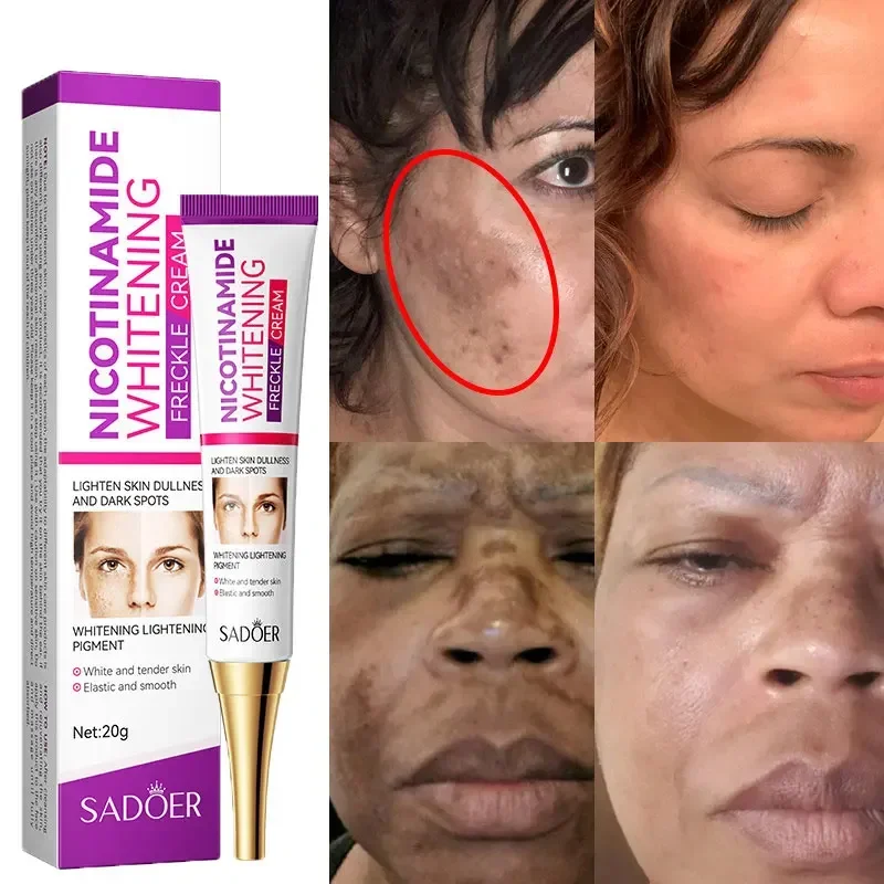 2024 neue Niacin amid White ning Sommersprossen creme entfernt Melasma effektiv schwarze Flecken Akne-Flecken hellt die Hautpflege auf