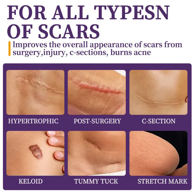 Żel silikonowy na blizny Szybkie odzyskanie po operacji Leczenie blizn Naprawa plam Zmiękczanie rozstępów Łagodzenie oparzeń Wybielanie Blizny Pielęgnacja