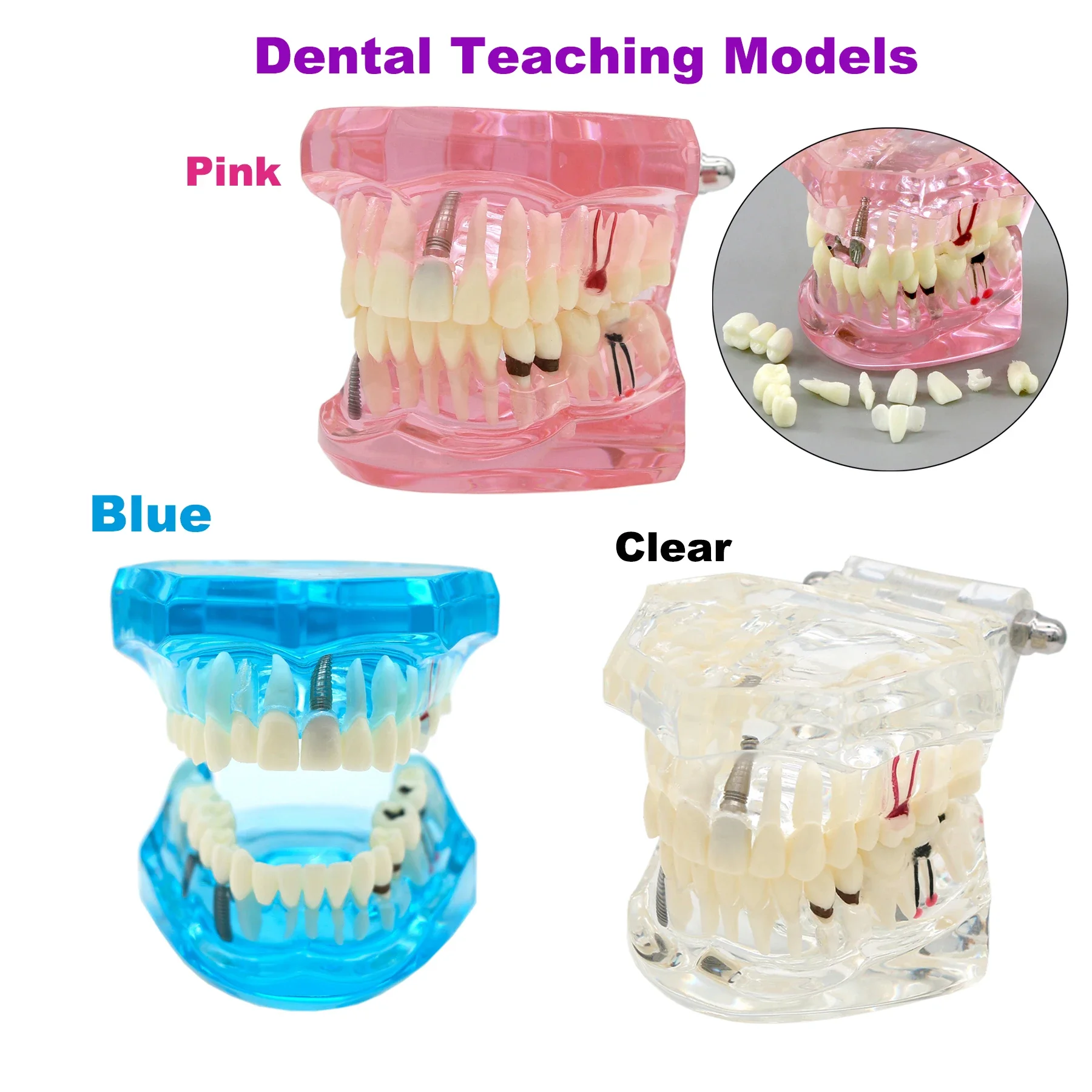 Dental Model Teeth Implant Orthodontic Periodontitis Standard Model Dental Teaching Display a variety of dental diseases Model