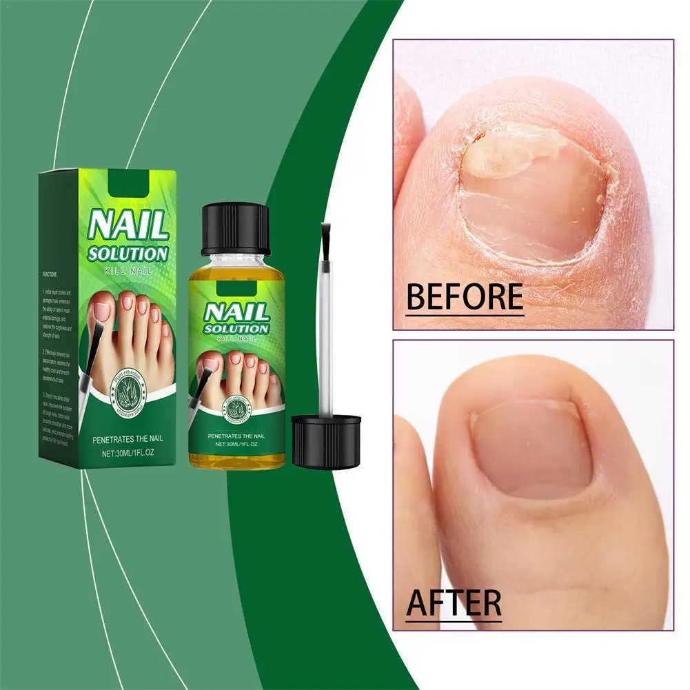 30ml Nail Repair Solution Liquid Anti-infective Paronychia Onychomycosis Nourishing Nails Fungal Removal Gel Foot Care