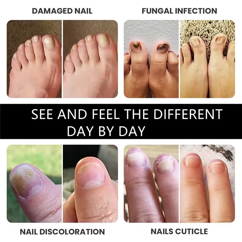 7 Days Nail Fungal Treatment Essential Oil Foot Toe Nail Fungus Removal Serum Repairs Onychomycosi Anti Infection Care Products