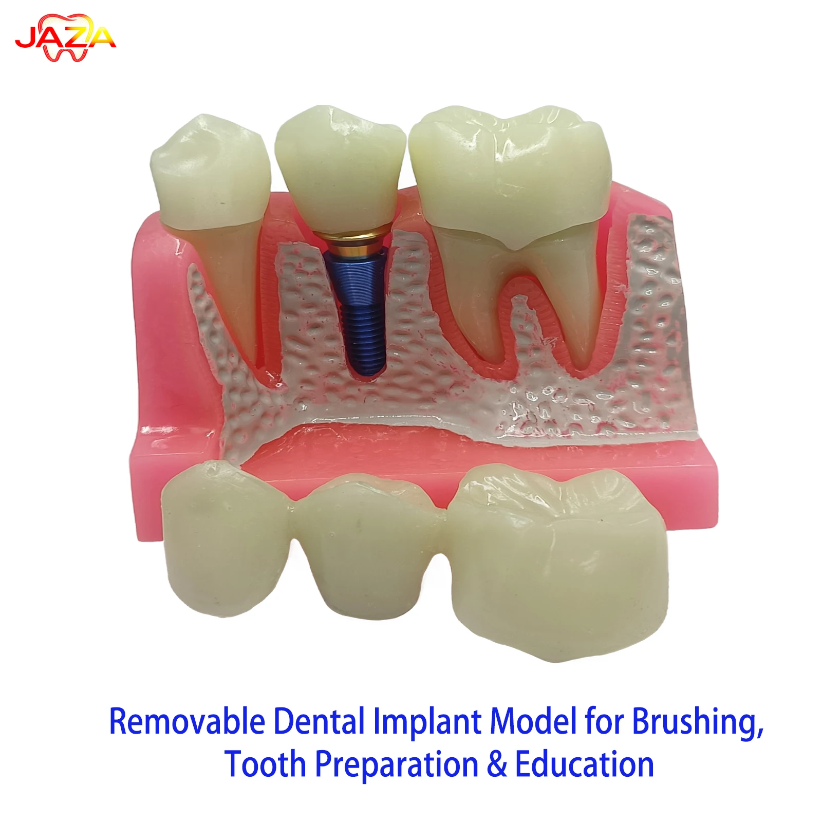 

Съемная модель зубного имплантата для чистки и подготовки, учебный инструмент для стоматологов и демонстрации клинических коммуникаций с пациентами