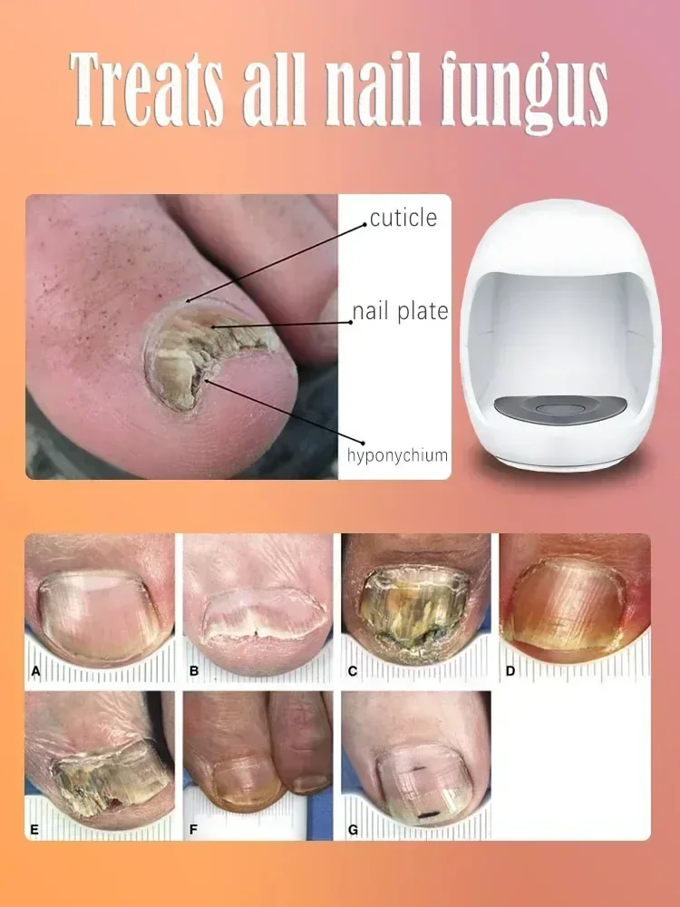 Fungal Nail Laser Onychomycosis Fungus Nails Repair Fast