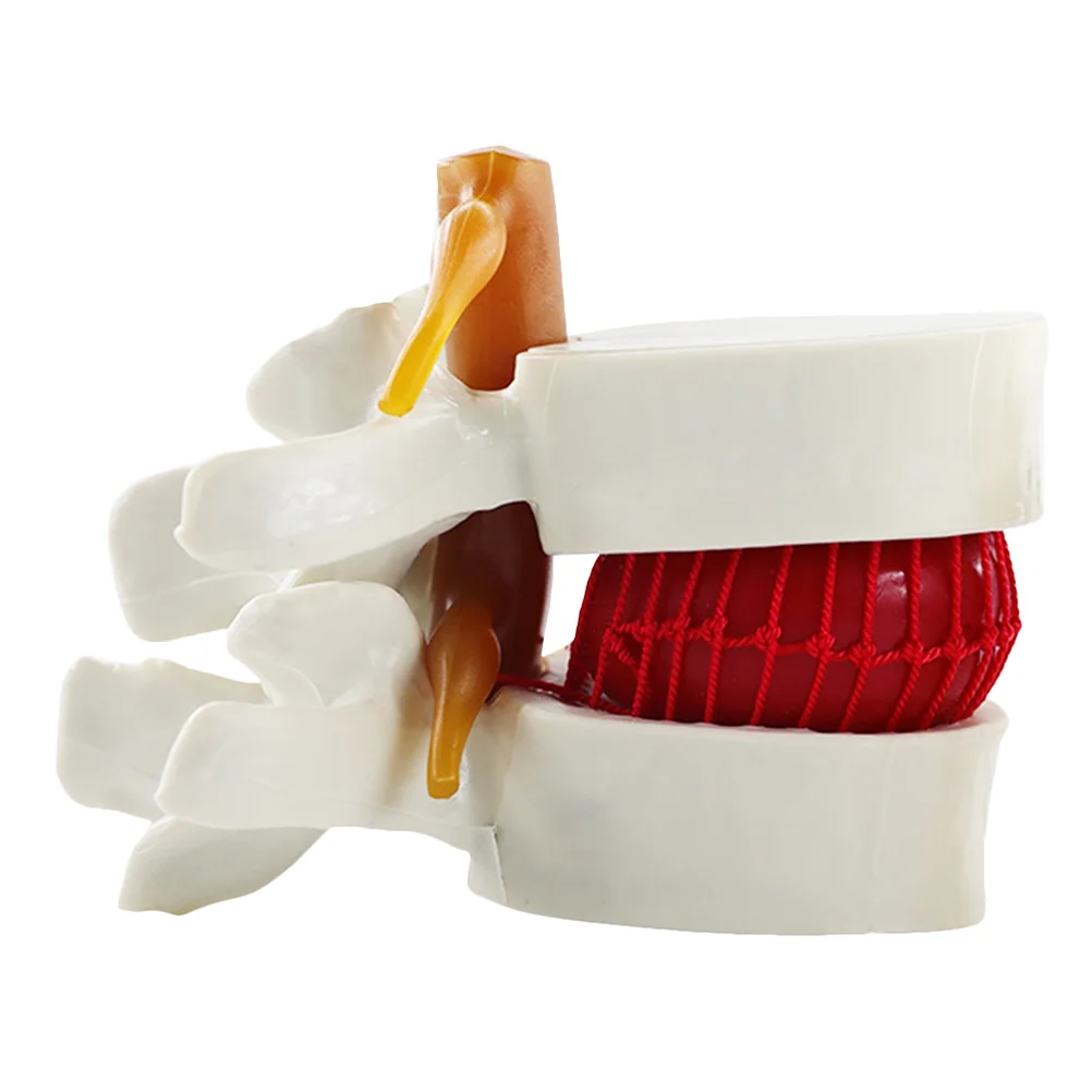 Mannequin Intervertebral Disc Model Models Lumbar Herniation Demonstrating Spine for