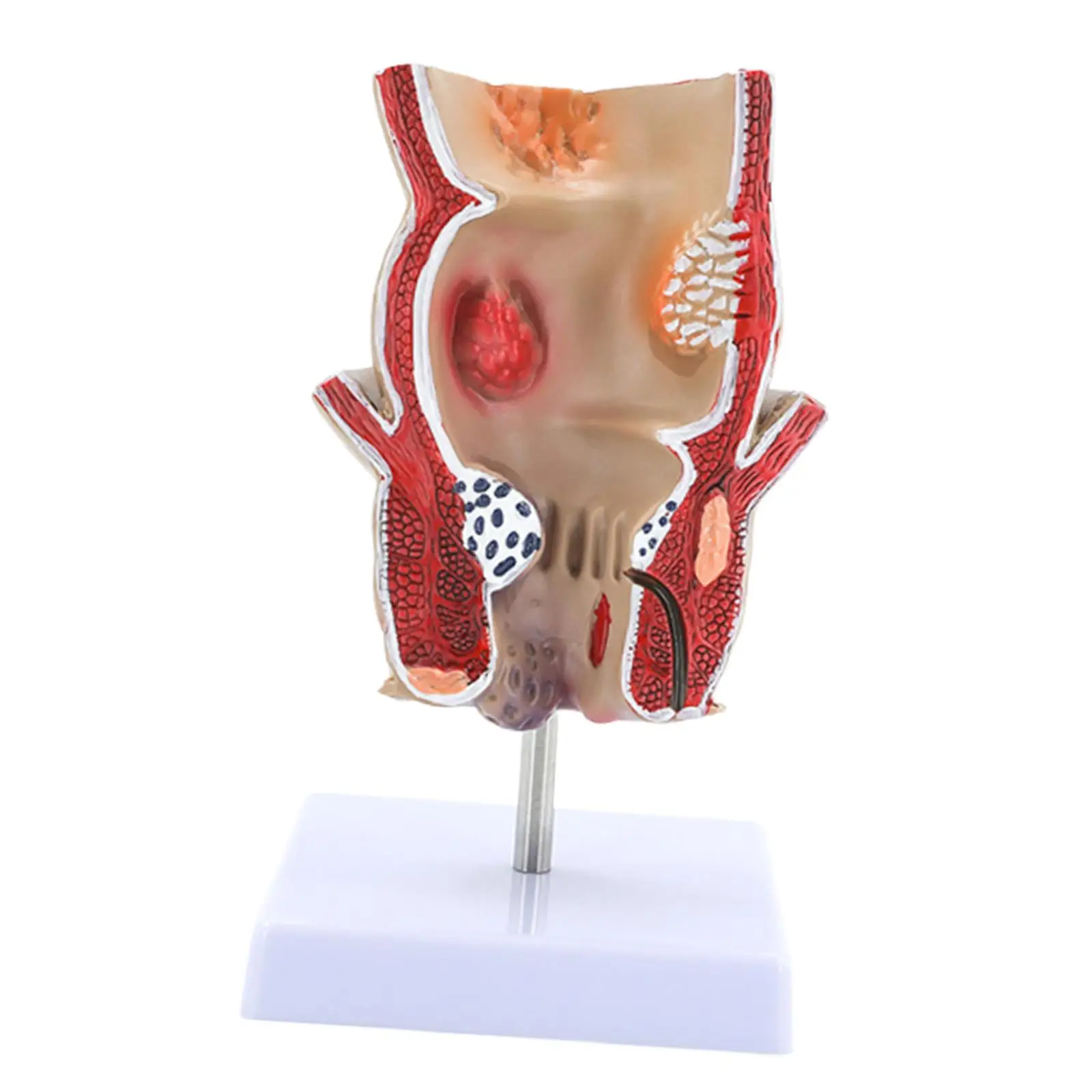 

Human Rectal Hemorrhoid Pathological Model Practical Intuitive Education Display Tool Anatomical Model for School Study Learning