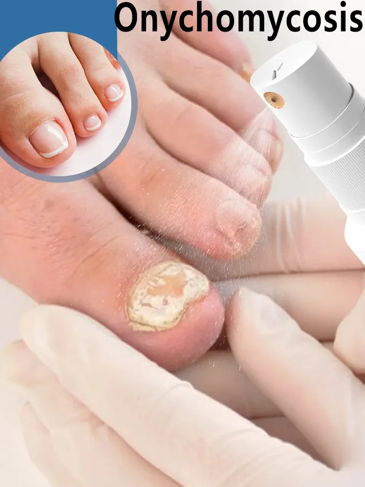 Spray antimicótico para uñas: limpia las uñas dañadas y descoloridas, fácil de usar.