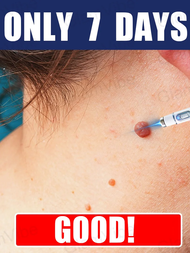 

2025 New Upgrade Blue Laser Solve Wart Tool