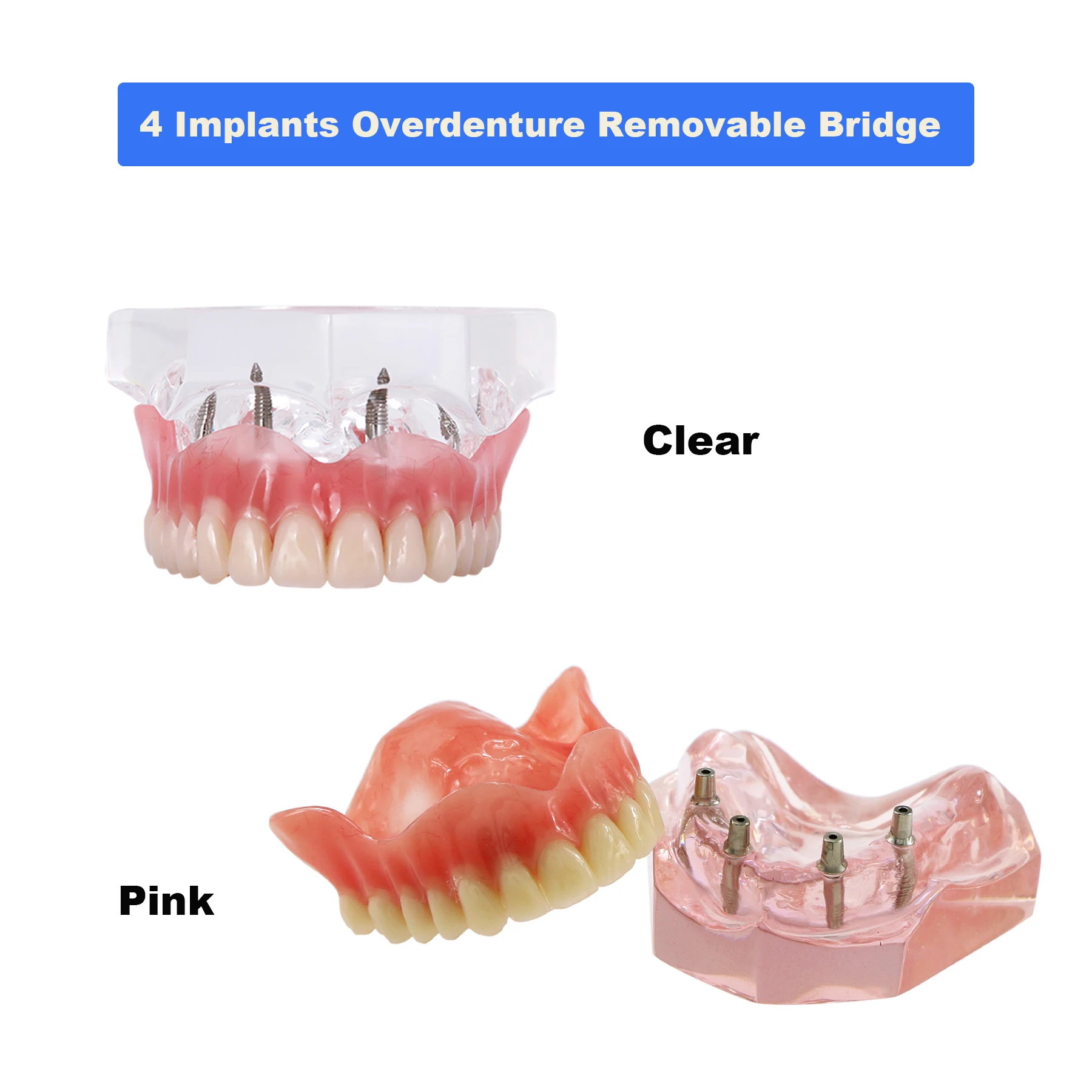 Dental Teeth Model With 4 Implants Overdenture Restoration Bridge For Dentist Implant Treatment Demo Teaching Model