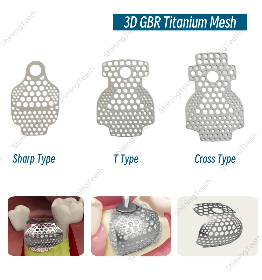 

Dental Implant GBR 3D Titanium Membrane Mesh System Flexible and Safety Bone Regeneration Barrier Membrane For Periodontal