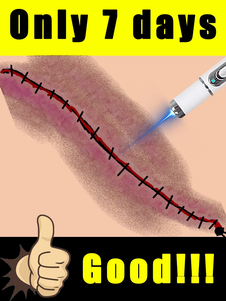 

free shipping,Generation-2 blue light pen solve scar,scar care tools,unisex,free shipping