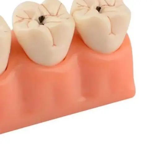 

Учебные инструменты для стоматологов: Модель зуба с кариесом, демонстрация процесса разрушения зубов при заболевании кариесом