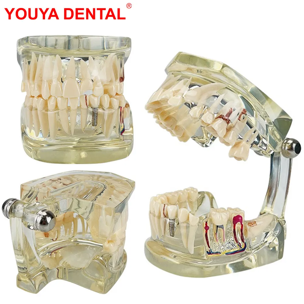 Anatomy Dental Model Teeth Teaching Model Transparent Jaw Model Dentistry Pathology Anatomical Teeth Model For Studying Typodont