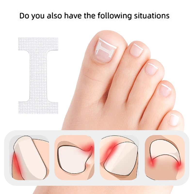 10Pcs I-shaped Ingrown Toenail Correction Clip Sticker Pedicure Toe Tools Nail Treatment Elastic Straightening Clip Brace