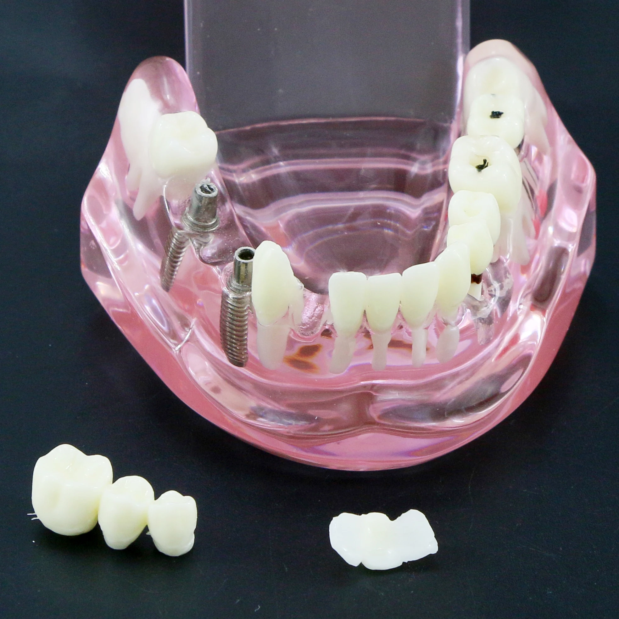 Dental Teeth Model Teaching Model Implant Disease Teeth Repair Restoration Bridge for Dentist Teaching Studying Demo M2001 Pink.