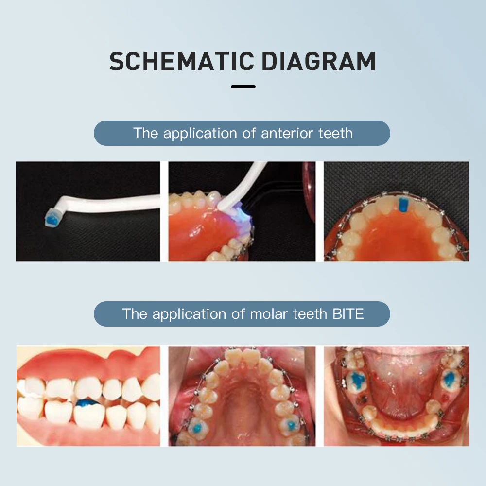Стоматологический ортодонтический адгезив для фотополировки синий клей в комплекте