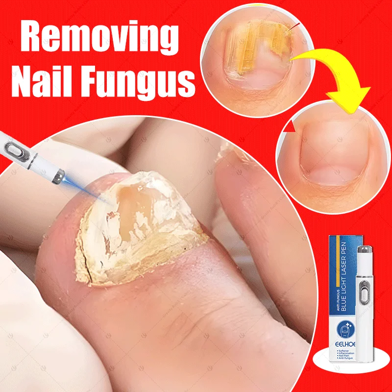 

"nail fungus laser treatment "