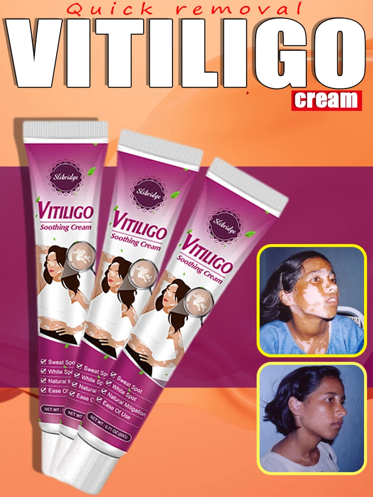 Crème d'élimination rapide du vitiligo en 7 jours, résiste efficacement aux taches blanches et améliore l'immunité de la peau