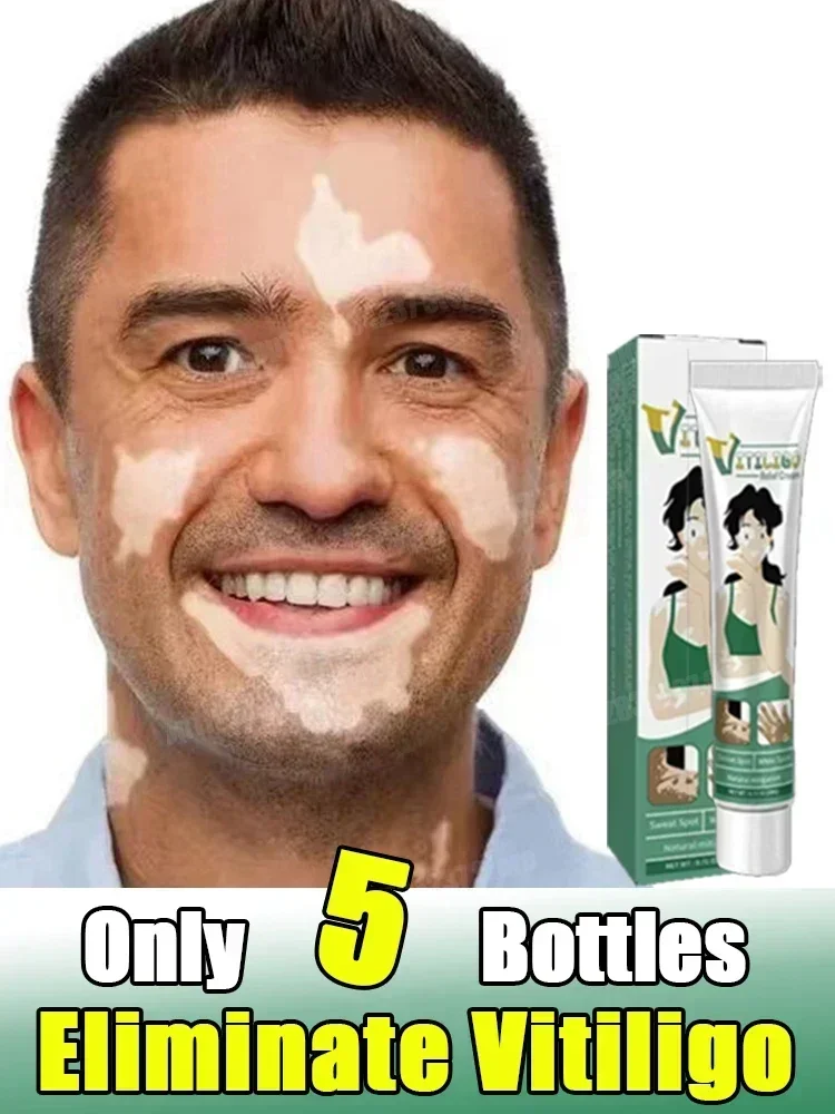 White Spot Care Cream Skincare cream vitiligo skin Sweat spot Reduce white spots Skin care Vitiligo Removal Cream