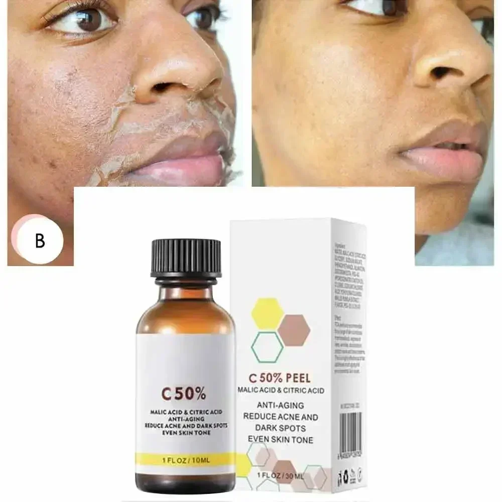 High Quality 50% Chemical Peel Peel Acid Skin Superforce Peel Pigmentation Lightening Melanin Acne Treatment Remove Scar