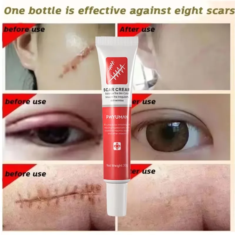 Fast Scar Removal Cream Effective Treatment Stretch Marks Burn Surgical Scars Acne Spot Repair Whiten Moisturize Herbal Skincare