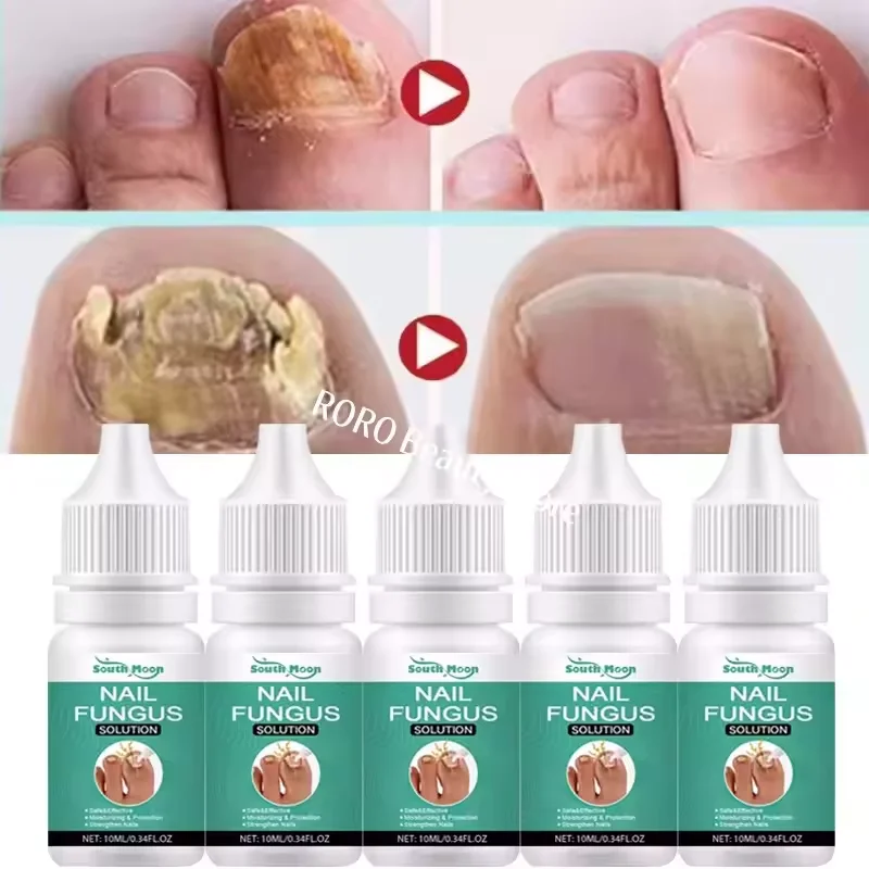 علاج الأظافر الفطرية جوهر النفط فطريات الأظافر جهاز الليزر إصلاح أظافر أظافر الزنجبيل علاج اليد القدم جوهر السائل