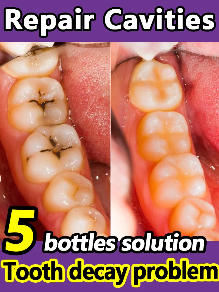 

Tooth Decay Repair Decay Cavities Anti Caries