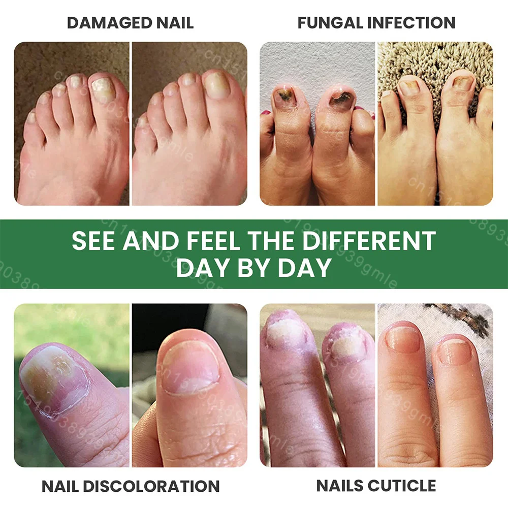 7 Days Nail Fungal Treatment Essence Oil Foot Toe Nail Fungus Removal Serum Repair Onychomycosi Anti Infection Gel Care Products